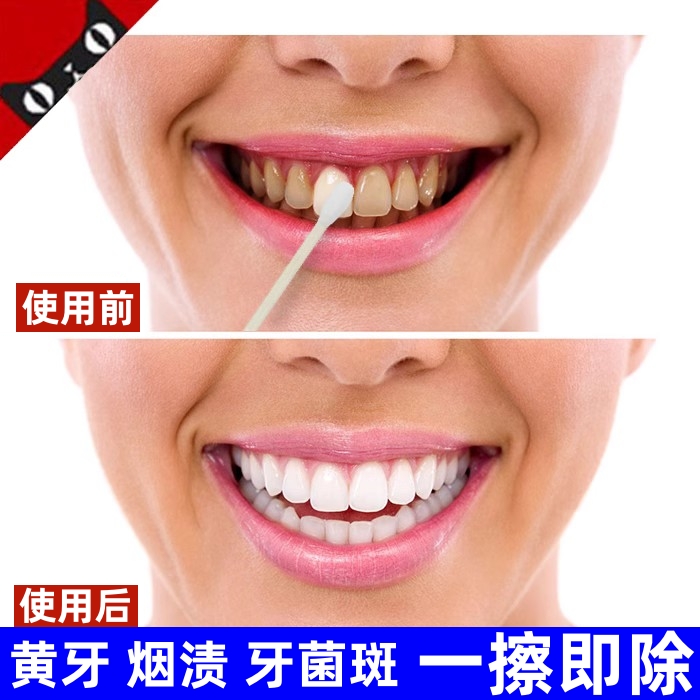 牙斑净牙齿美白速效去除黄牙烟渍黑渍去黄洗牙清洁祛除牙菌斑神器