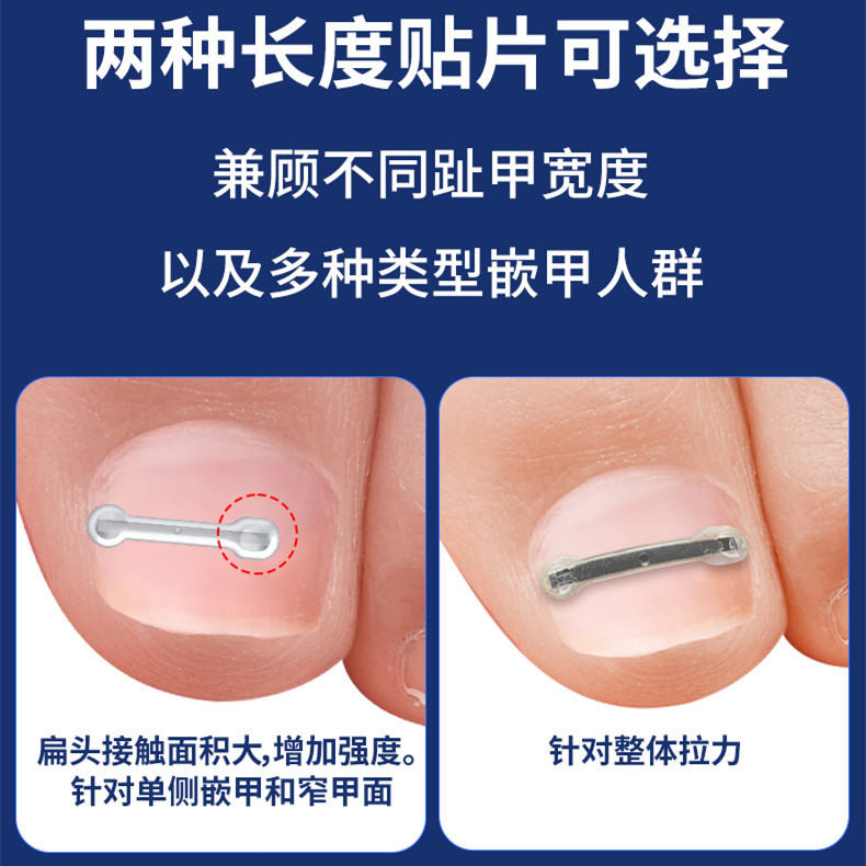 甲沟嵌甲指甲矫正器炎正甲贴片脚趾甲盖内嵌往肉里长专用指甲刀剪