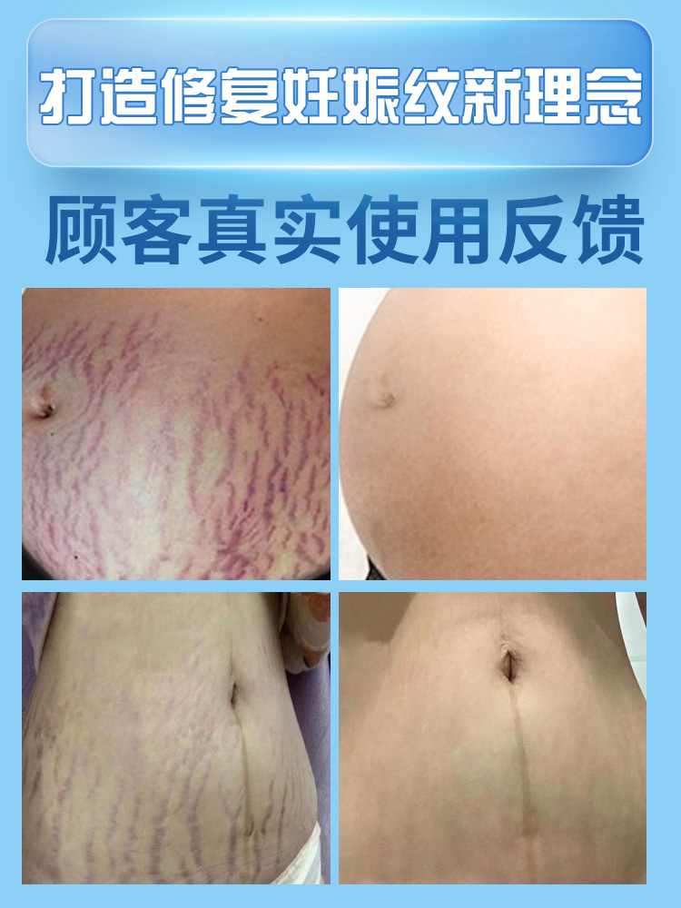 Remove stretch marks, postpartum repair cream, remove obesity lines, stretch marks, lighten and firm growth marks, and prevent special prevention for pregnant women