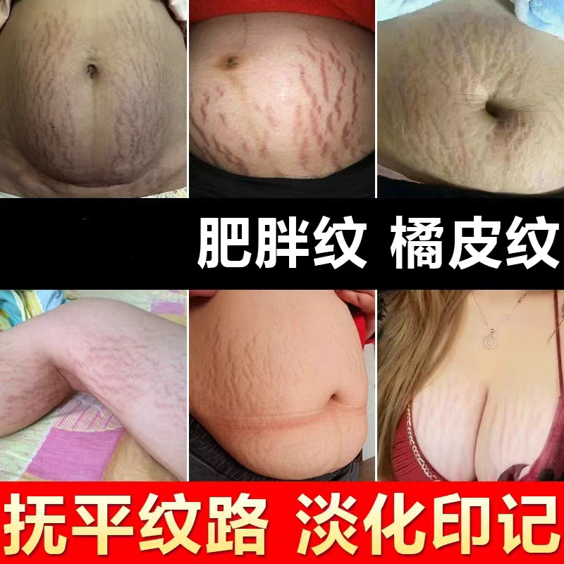 去妊身纹修户霜修户肚纹 肥胖纹大腿生长纹紧致淡化身体乳护肤