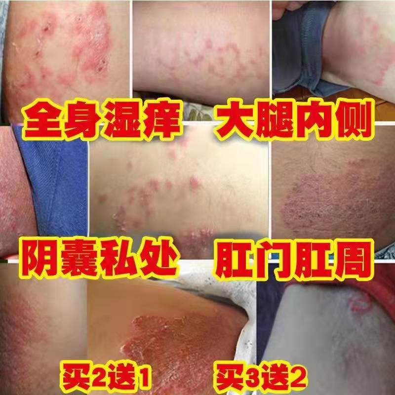 股癣大腿内侧囊瘙痒真菌感染湿疹肛门阴私处藓癬男女专用屁股