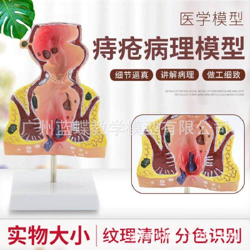 专业肛管直肠疾病模型 人体直肠病理模型 肛楼探针 痔疮模型 肛门