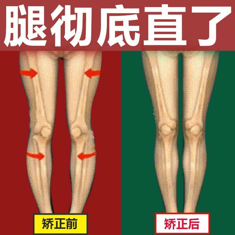o型腿矫正神器直腿鞋垫 o形腿xo型x型腿矫正器小腿外翻脚纠正腿型