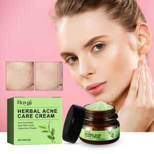 Treatment reduces Hoygi Acne acne marks fades Herbal Cream