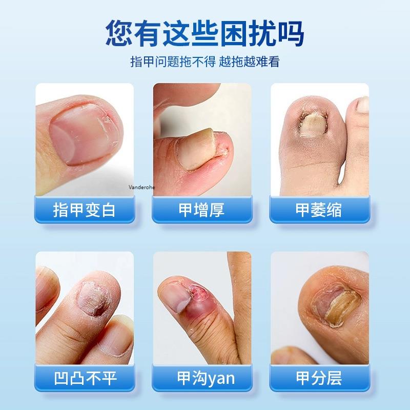 甲姿净香港大药房手足喷雾亮甲止痒膏脚气药水草本抑菌灰指甲喷剂