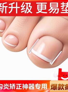 Nail Correction Device, Nail Stickers, Special for Ingrown T