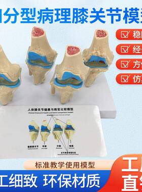 病态膝关节模型四阶段病理膝关节模型病变人体膝关节模型