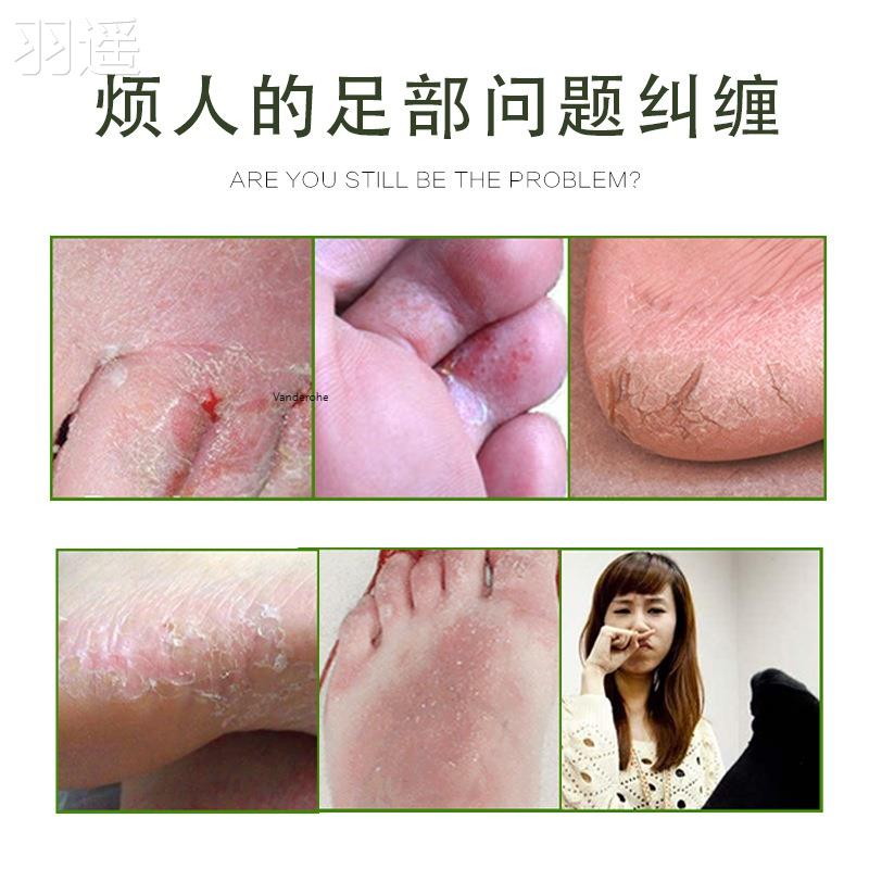 脚气草本抑菌止痒膏脚臭脚痒脚汗脱皮干裂烂脚足部护理膏