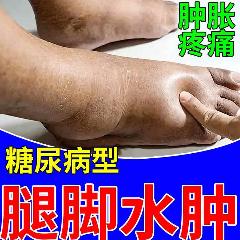 老人糖尿病脚肿消肿下肢水肿小腿浮肿胀脚背药水肿胀痛可搭膏贴QK