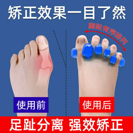 脚趾头弯曲矫正器大脚趾上翘二脚趾小脚指变形五指内翻分趾器分离