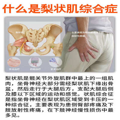 梨状肌综合症腰突压迫坐骨神经痛腰大小腿疼屁股疼久坐不动专用贴