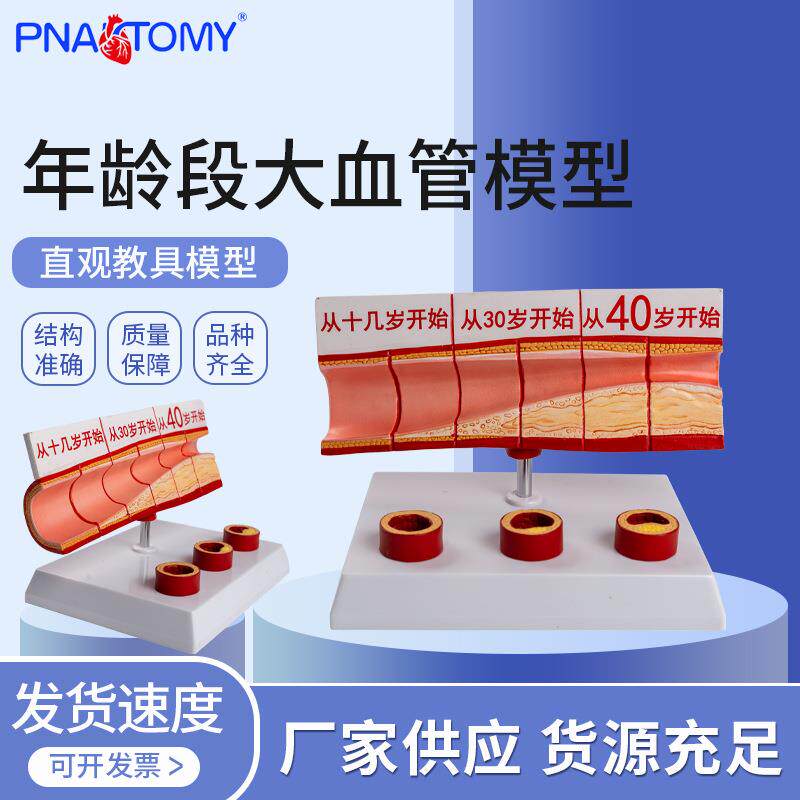 年龄段大血管模型 4部件 /硬化心血管动脉/ 硬化模型血管病理模型