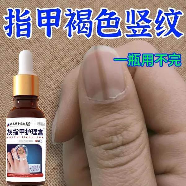 噜噜鼠正品甲母痣指甲有黑色竖条纹指甲上长黑线线专外用膏灰指甲