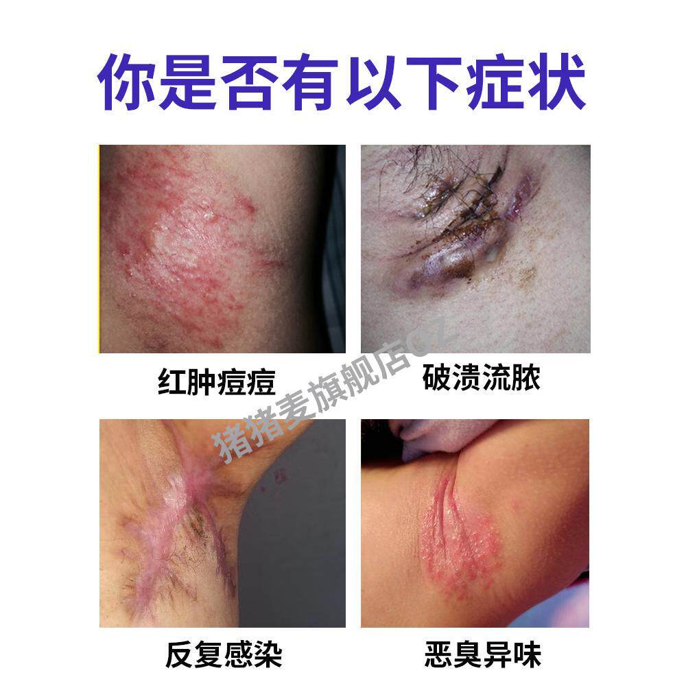化脓性大汗腺炎腋下囊肿襄消红斑炎药房同款膏腋窝汗腺发达OZ0756