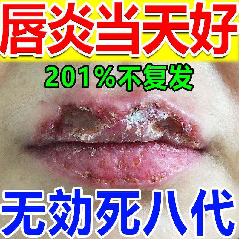 口周唇炎润唇膏修护唇炎唇膏嘴唇干 干裂脱皮嘴巴干 干燥起皮烂嘴