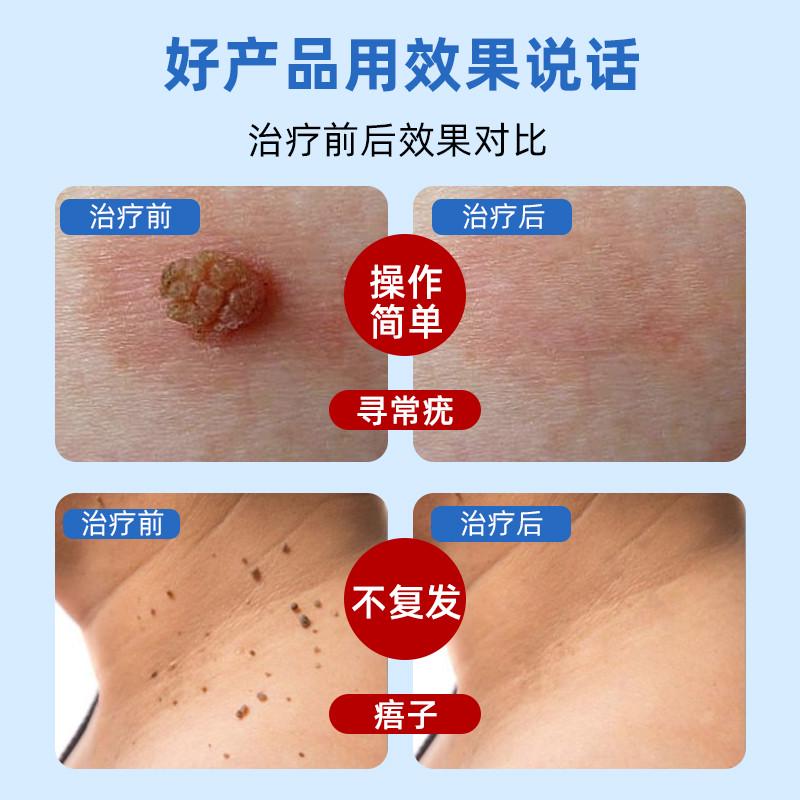德国液氮冷冻去疣医用小瓶罐装干去除肉粒疙瘩肉刺瘊子祛根专用克