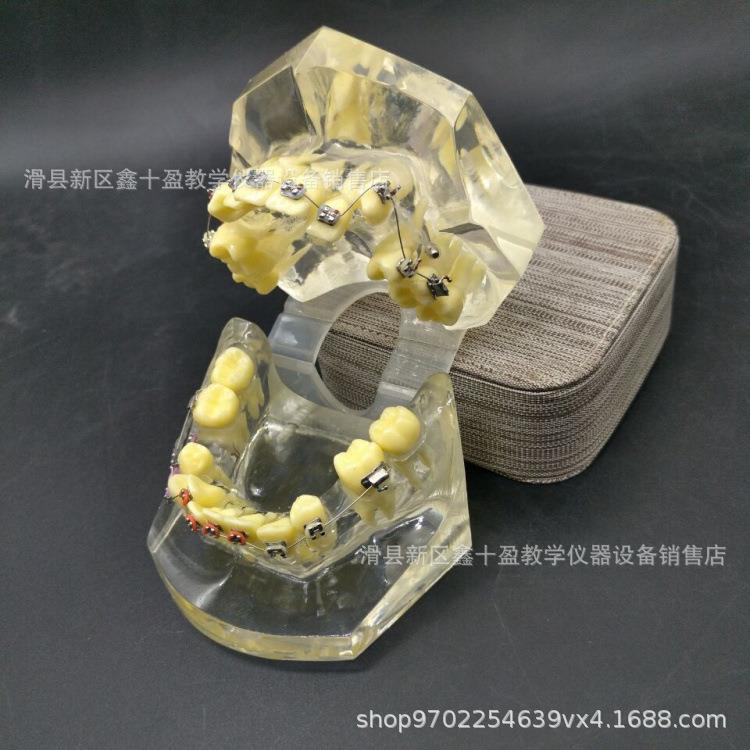 正畸模型 错颌矫正牙齿示范 牙列不齐拥挤缺失伸长展示 带支抗钉