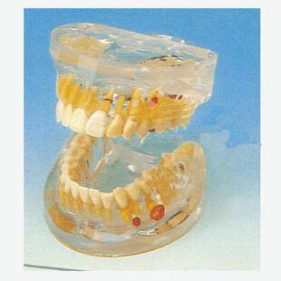 透明牙体病理模型B10011