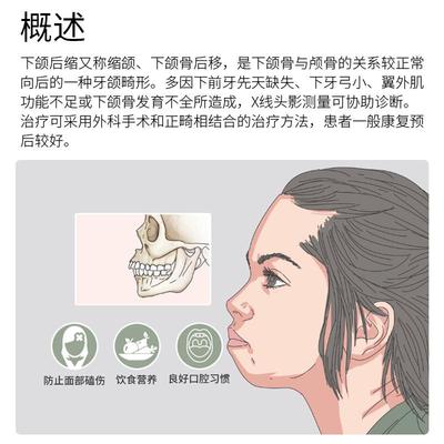 下颚后缩矫正器颞下颌关节紊乱固定带托下颌骨兜下巴托牵引器