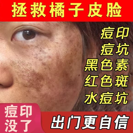 祛痘印黑色素沉淀去痘坑水痘，疤痕修复男女生消淡印炎却痘痘医用wg