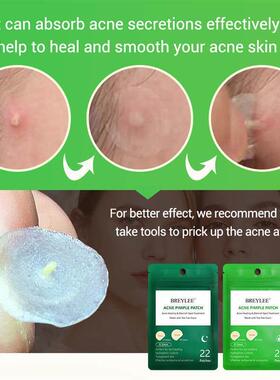 Acne Pimple Patch Stickers Treatment Pimple Remover 痘痘贴