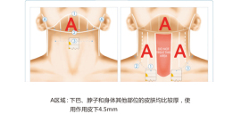 热玛家用脸部美容仪抗皱提拉提升紧致逆龄去眼袋童颜机射频仪