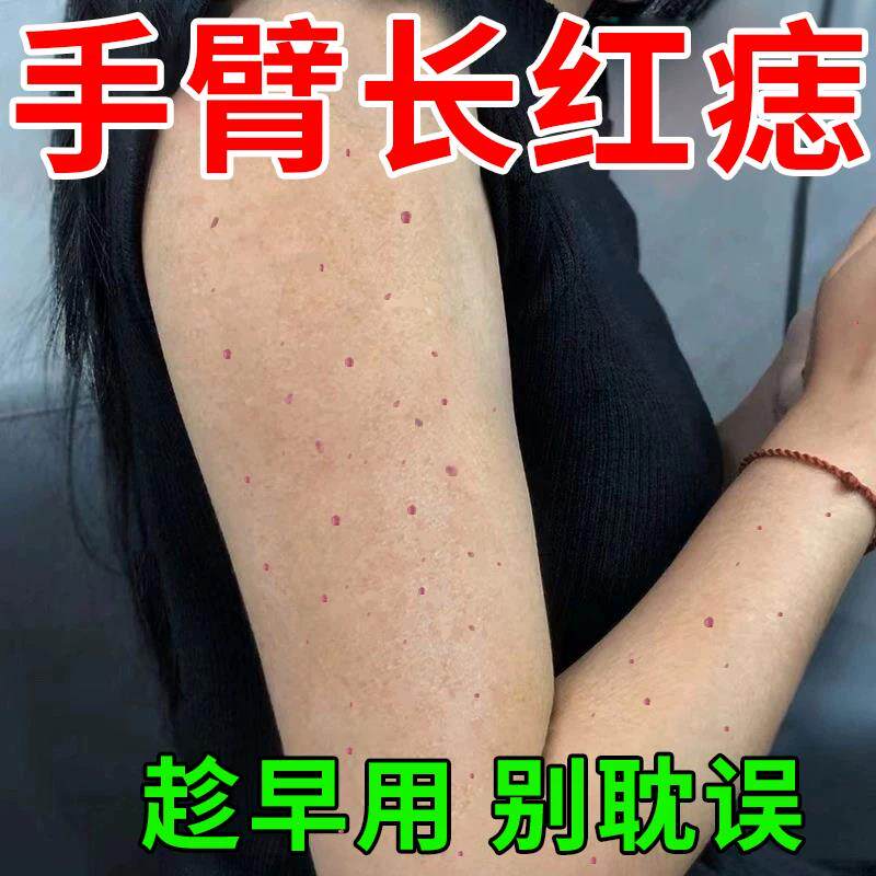 血管瘤血管痣樱桃状胳膊上手臂小红点痣凝胶专可搭用膏米喹莫特膏