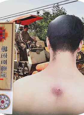 后背长火疖子毒气疙瘩脓包去毒疮红肿疼痛外用涂抹抑菌老牌子专用