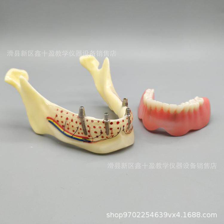 下颌骨种植解刨模型 半口义齿解说 种植钉位置示范牙神经骨本质