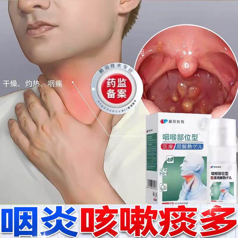 日本咽喉炎干痒喉咙有痰滤泡增生咳嗽慢性咽炎异物感肿胀支气管炎
