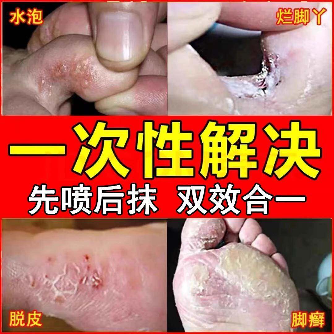 噜噜鼠正品狼毒脚气喷剂喷雾臭烂脚丫脱皮糜烂脚趾缝烂脱皮杀菌止