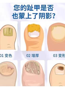 香大药房灰指甲甲部抑菌膏指厚脚港趾指甲膏足BHM护理偏方医康方