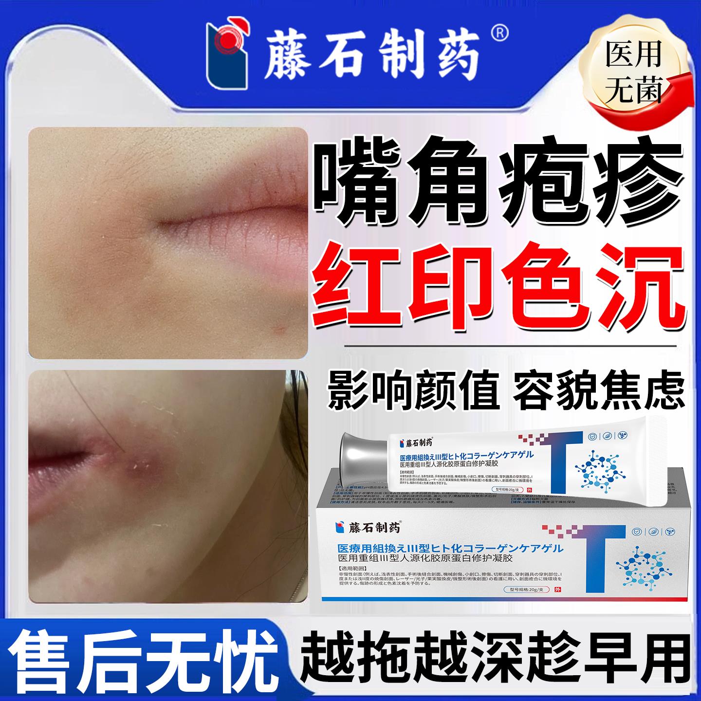 嘴角嘴唇疱疹嘴巴上火起水泡烂角后嘴红印黑印色沉去除修复祛疤RW