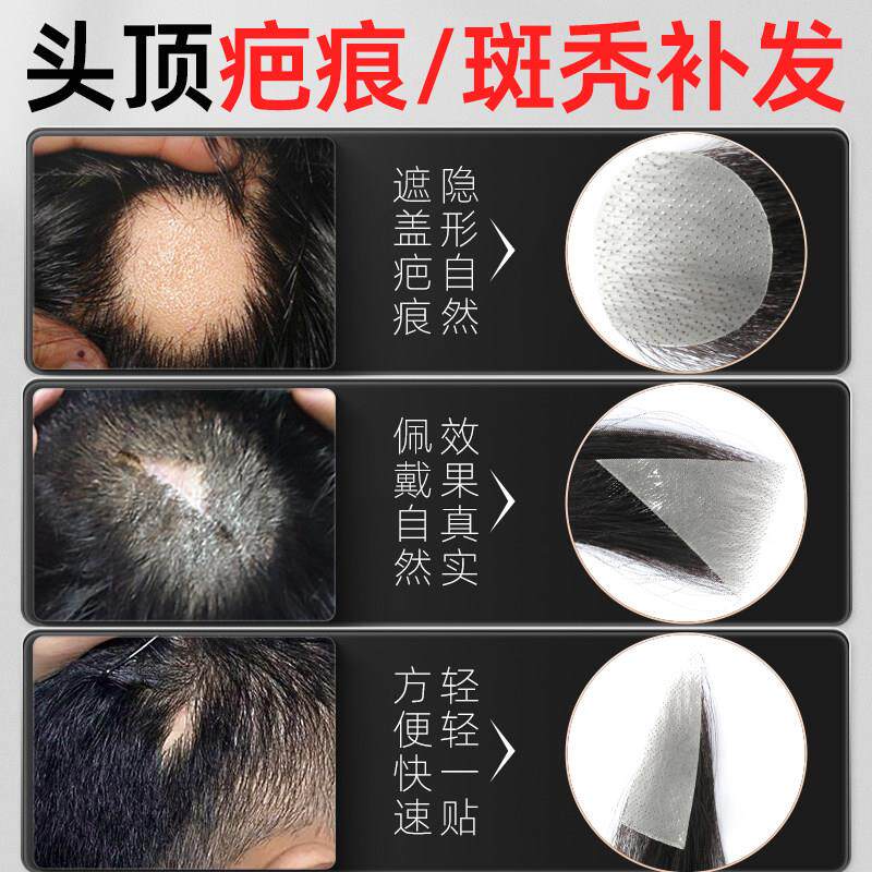 疤痕补发贴头部伤疤疤痕补发片斑秃假发贴片无痕隐形生物全真发顶