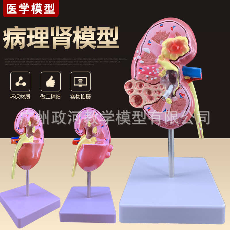 教学仿真病变肾脏模型病理肾脏标本肾脏解剖模型人体解剖模型教具