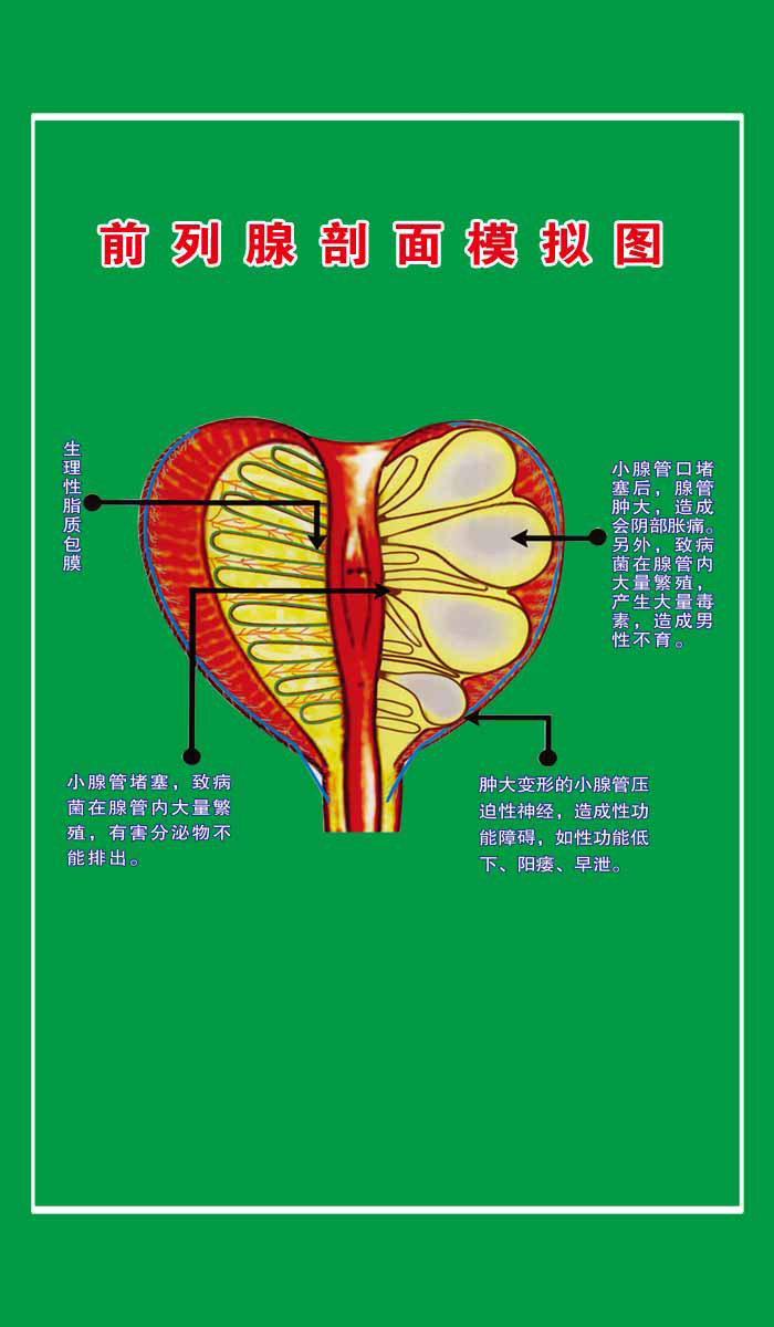 海报印制109素材常用挂图海报展板282前列腺剖面模拟图 挂图