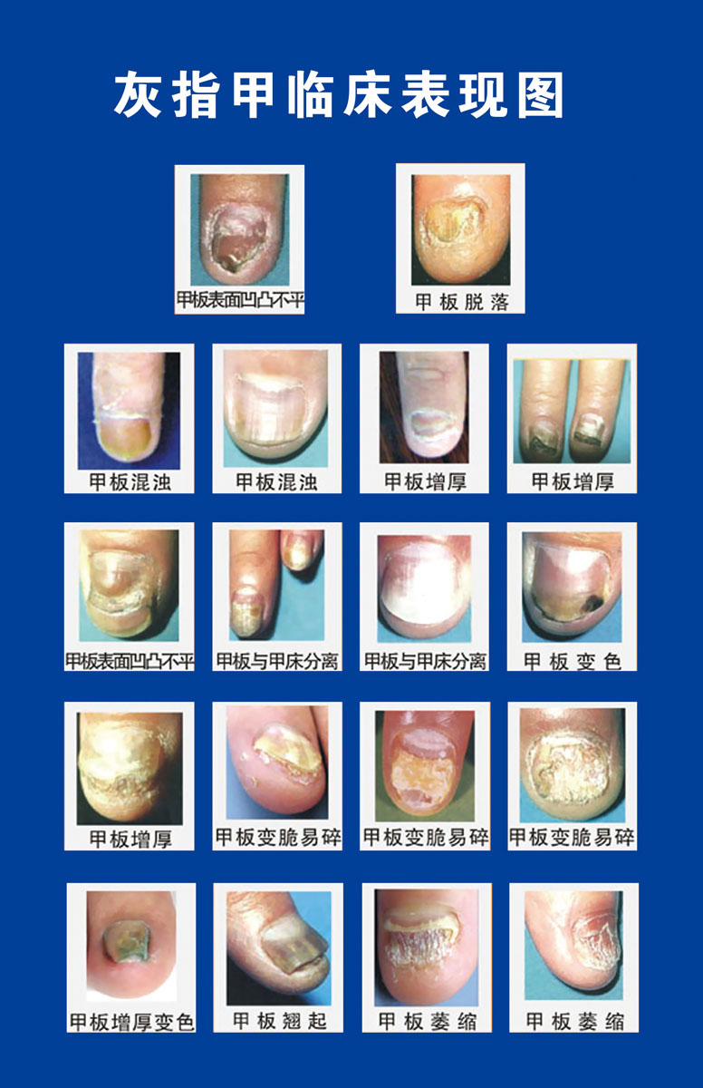 734海报印制展板写真喷绘贴纸692灰指甲临床表现图