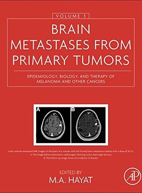 【预订】Brain Metastases from Primary Tumors...