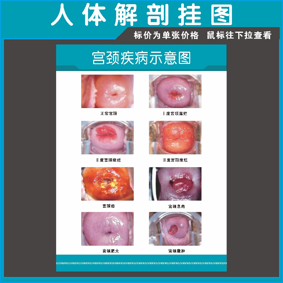 妇科宫颈疾病示意图医学宣传挂图人体器官解剖图医院布置海报42