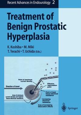 【预订】Treatment of Benign Prostatic Hyperplasia