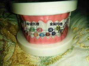 牙科正畸模型 金属托槽模型 陶瓷托槽模型 正畸模型