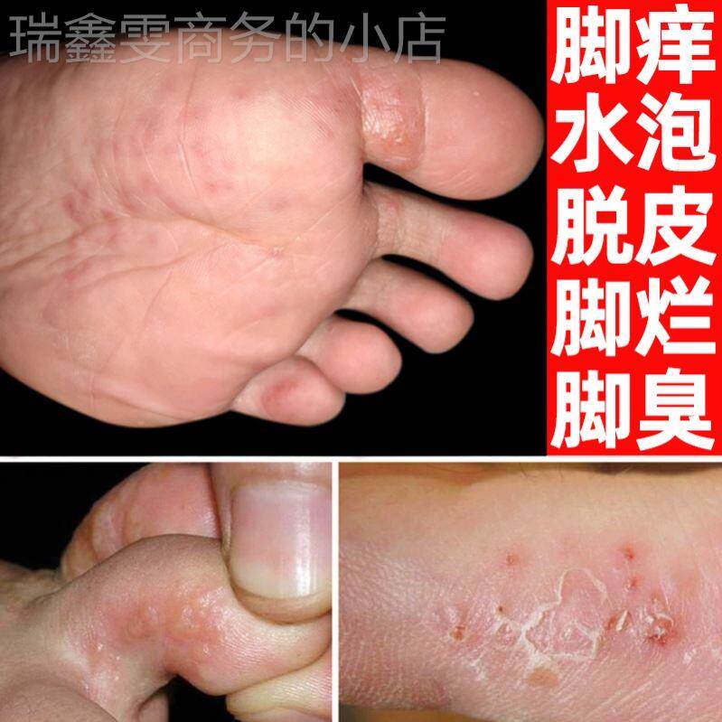 湿疹真菌感染 药膏脚背痒防裂脚气真菌水日本苗家偏方药膏脱皮擦