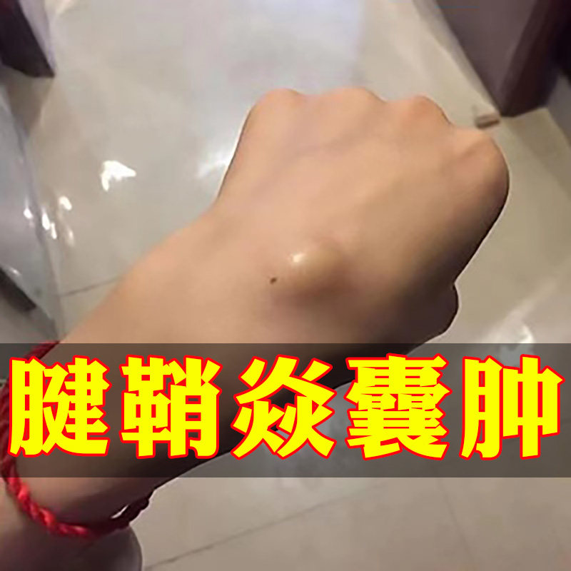 网红【腱鞘死对头】腱鞘炎专用膏腕关节鼓包手指僵硬变形拇指咔咔