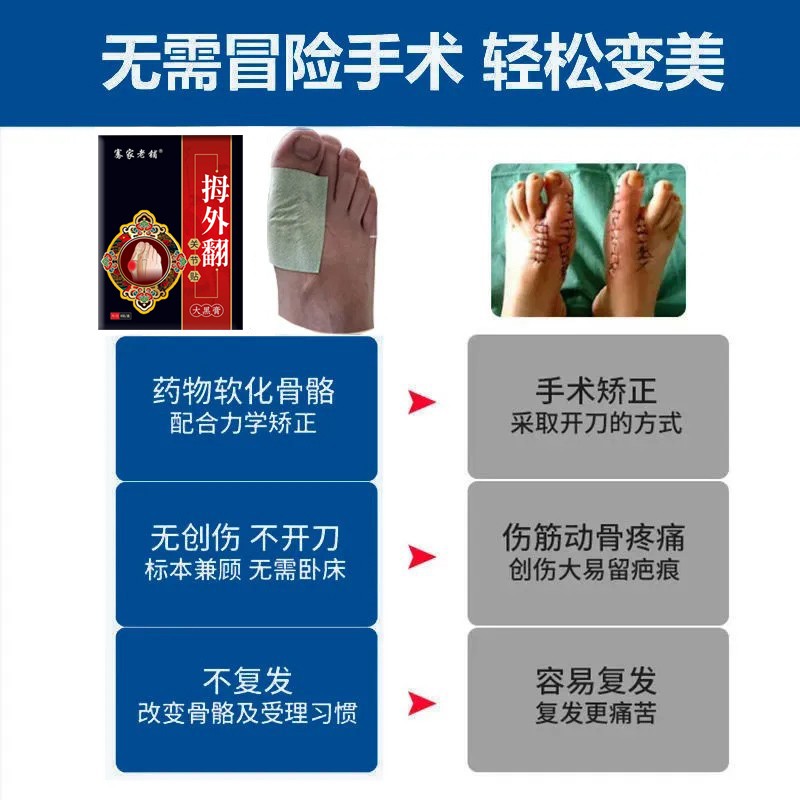 不直全骨】大脚外脚趾重叠专用膏贴拇赔翻神器拇指外翻矫正专用FF