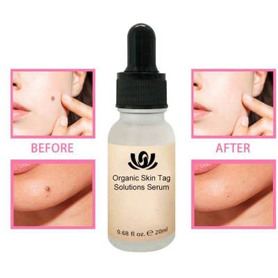 新品Organic Tags Solutions Serum Painless Mole Skin Dark Spo