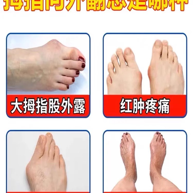工厂销大脚骨【j不外翻了】脚趾外翻矫正神器拇趾变形防磨男女足