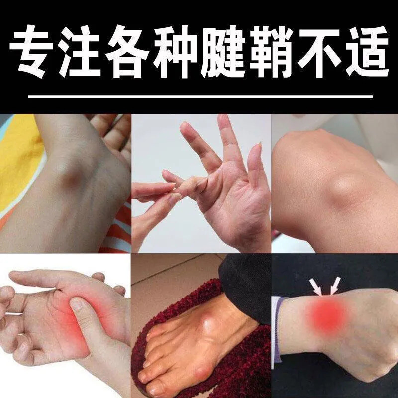 速发【10倍渗透】腱鞘膏手指脚趾关节疼痛鼓包专用手腕大拇指肿胀