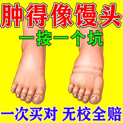 推荐祛脚肿水肿的药小腿部浮肿胀老人脚水肿的药泡脚利尿排肿排水