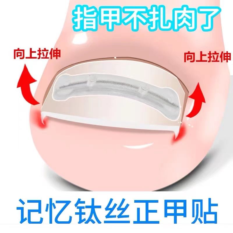 直销甲沟纠正甲片神器夹子指甲矫正器嵌甲隔离填充垫片脚趾甲长肉