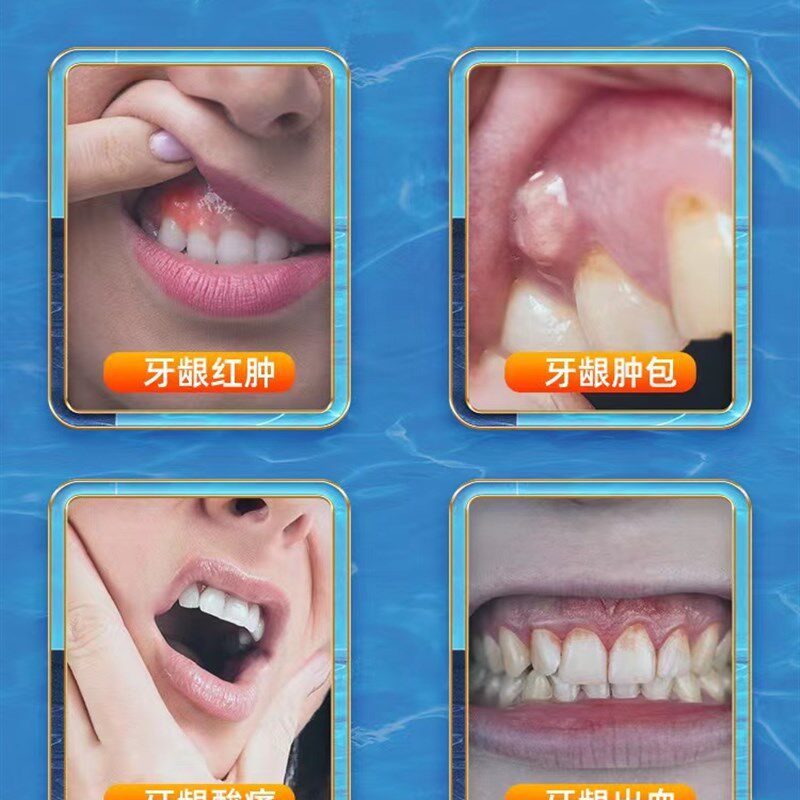 牙龈脓包肿包肿痛消焱上火智齿发炎牙h根i周焱鼓包出血专用药喷剂